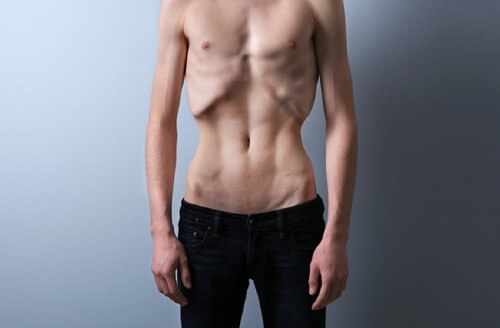 بی اشتهایی عصبی