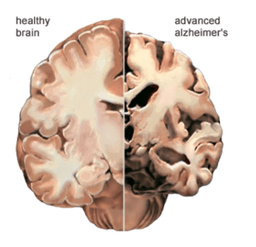 علائم زوال عقل