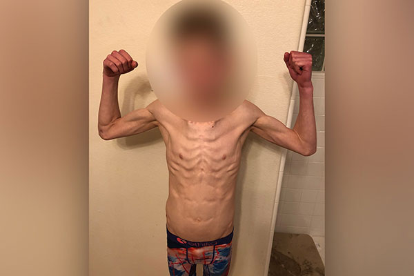 عواقب آنورکسیا عواقب آنورکسیا