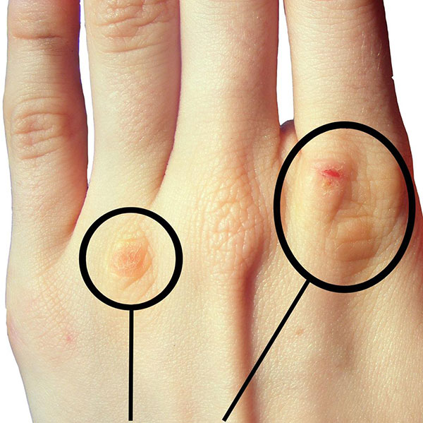 علائم بولیمیا علائم بولیمیا