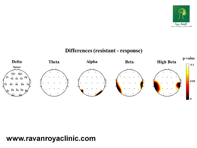 انواع امواج مغزی