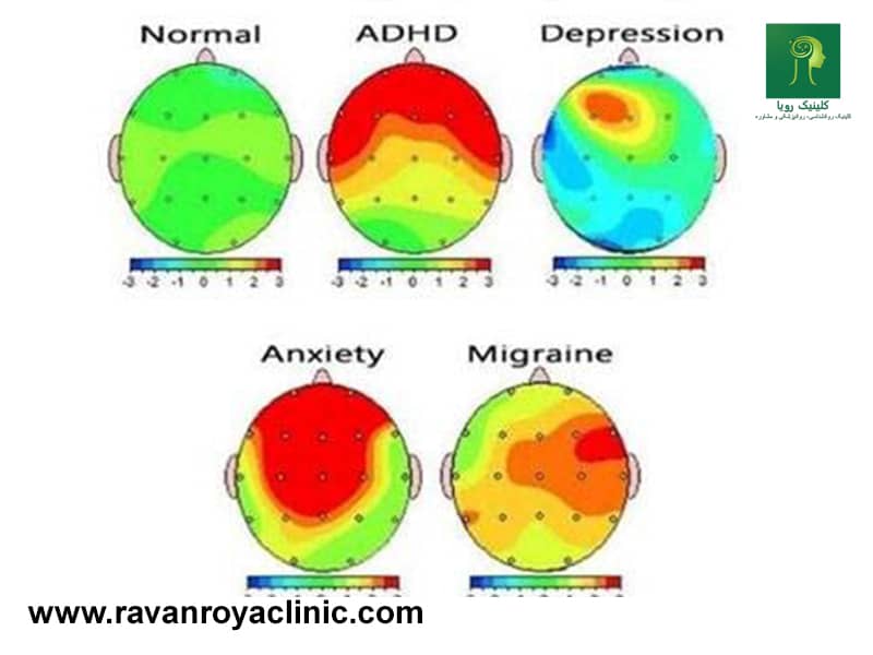 راهنمای تفسیر نقشه مغزی