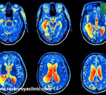کاربرد نقشه مغزی در تشخیص اختلالات