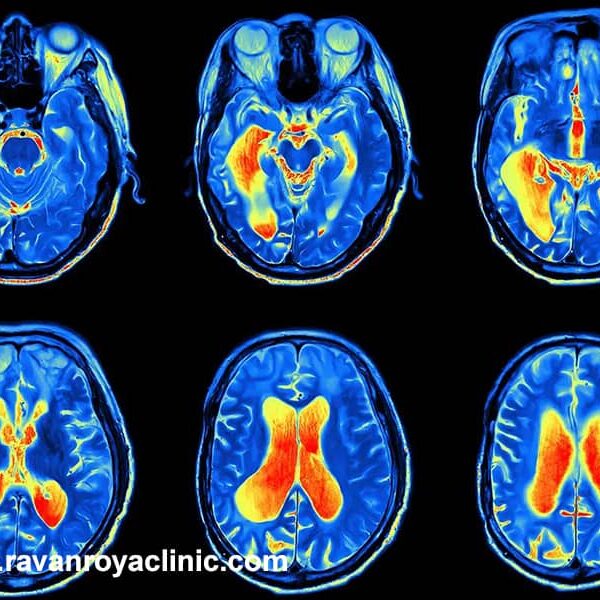 کاربرد نقشه مغزی در تشخیص اختلالات کاربرد نقشه مغزی در تشخیص اختلالات