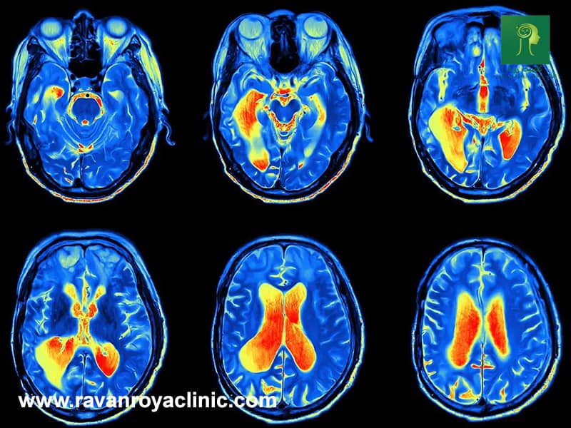 کاربرد نقشه مغزی در تشخیص اختلالات